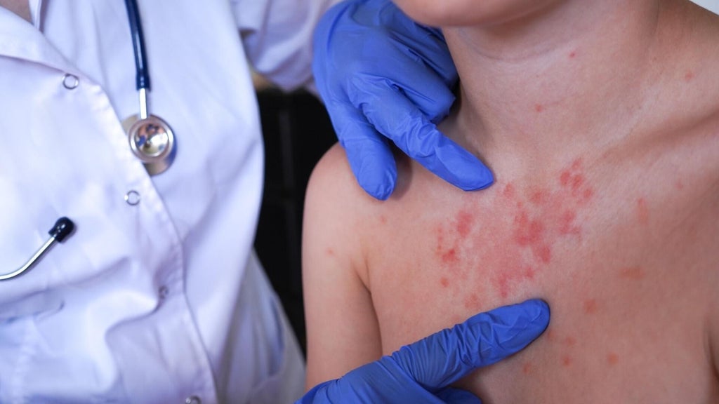 Minnesota's 80 measles cases this year are the most since 1990, health officials say — Farmington Health news